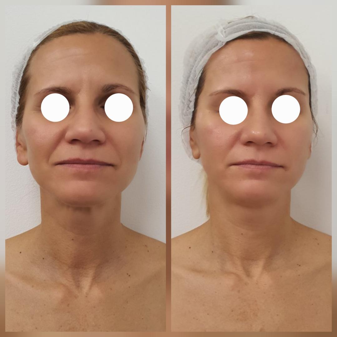 Beauty Vreme za mene #novisad Tretman lica AKCIJA 9D HIFU LICA ,VRATA,PODBRATKA +HIGIJENSKI TRETMAN+OXYGEN TRETMAN