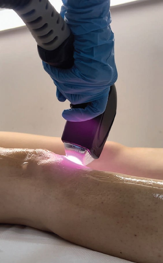 Valija #beograd Laserska epilacija Laserska epilacija celih nogu - za dame