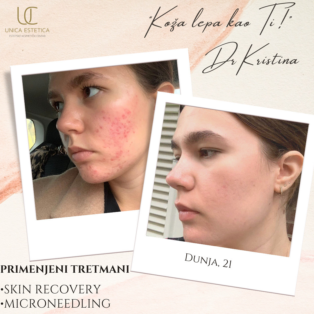 Unica Estetica #nis Tretman ožiljaka Microneedling tretman akni