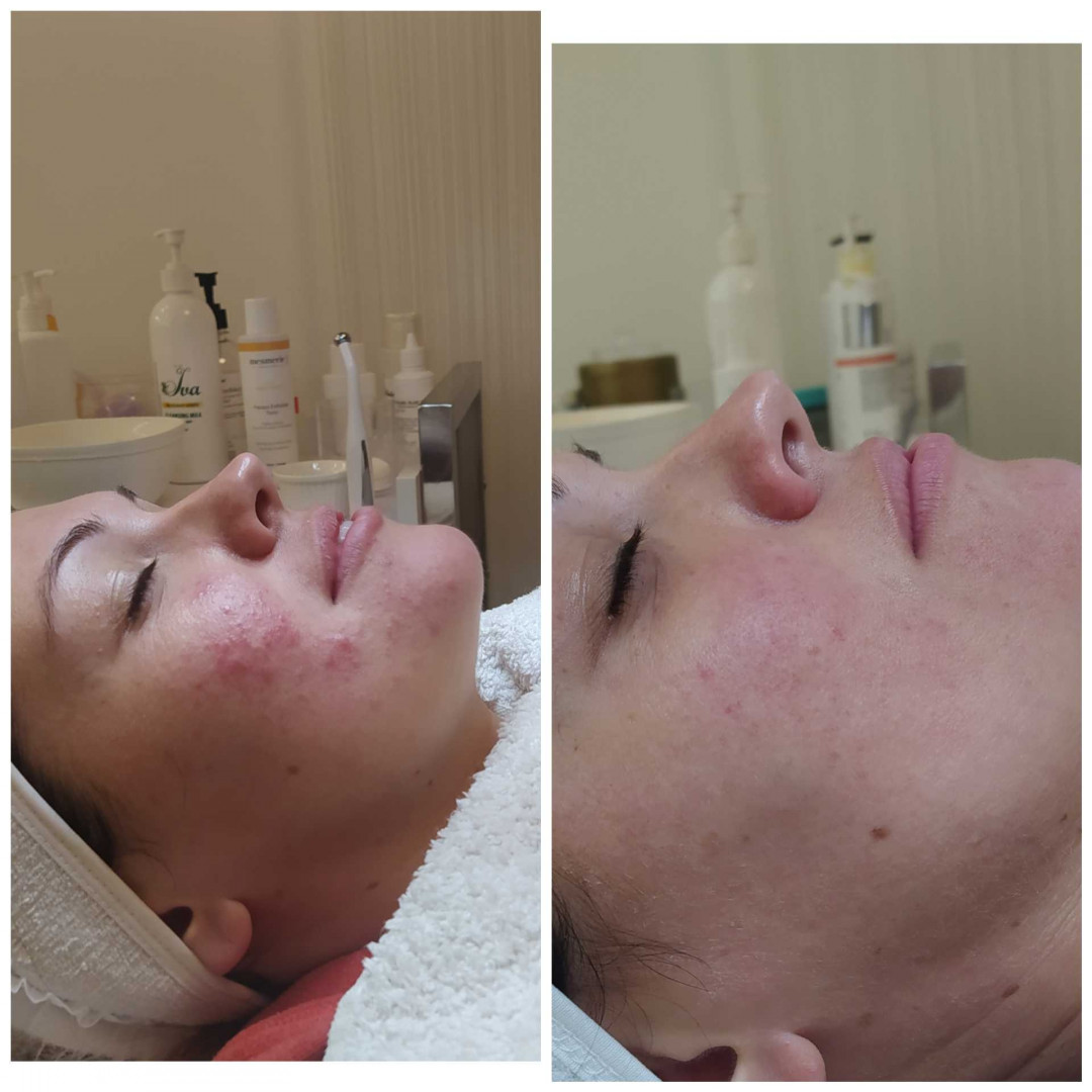 Higijenski tretman lica +FITOPILING - Iva Beauty Lab, Beograd Tretman lica Lice Tretman lica, Beograd, Dušanovac, Šumice