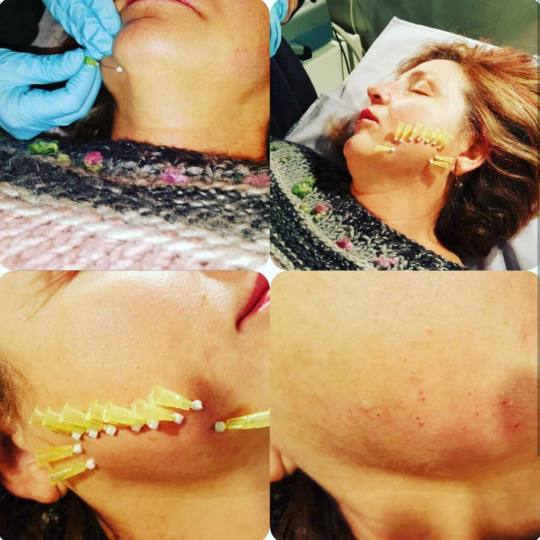 Grossi cosmetic #beograd Tretman lica