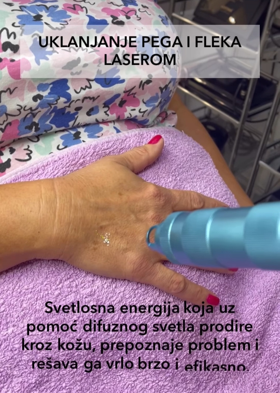 Laser centar Delight #beograd Laserski tretmani lica Uklanjanje pega i fleka laserom