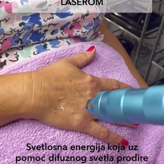 Laser centar Delight #beograd Laserski tretmani lica Uklanjanje pega i fleka laserom UKLANJANJE PEGA