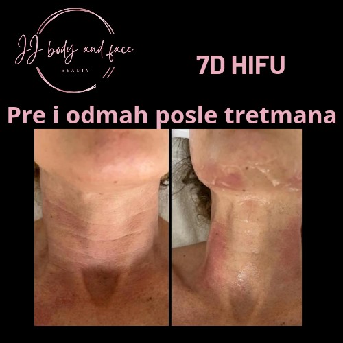 Beauty by Sanja #novisad Tretman lica Akcija Hifu tretman - lice + vrat + podbradak