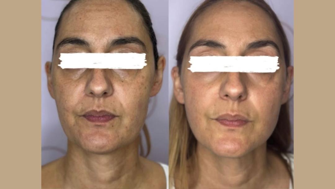 AWT tretman lica - Attento Aesthetic, Beograd Tretman lica Lice Tretman lica, Beograd, Zvezdara