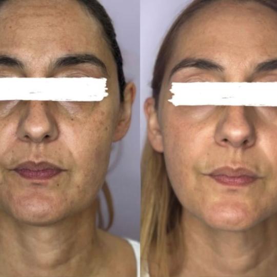 Attento Aesthetic #beograd Tretman lica AWT tretman lica HIFU (fokusirani ultrazvuk) je nehirurški 