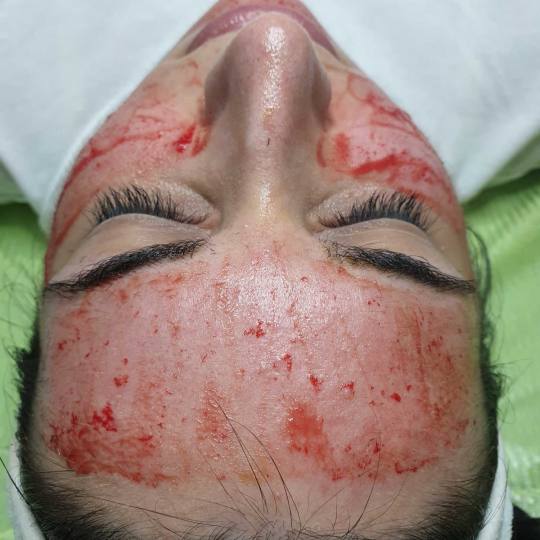 Tina B #beograd dermapen