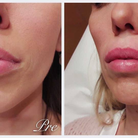 Eden #beograd Tretman lica Biopolimer