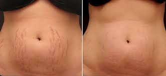 Vila Beauty Studio #beograd Tretman lica Plasma pen (po regiji)