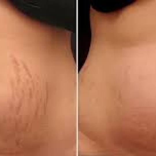 Vila Beauty Studio #beograd Tretman lica Plasma pen (po regiji)
