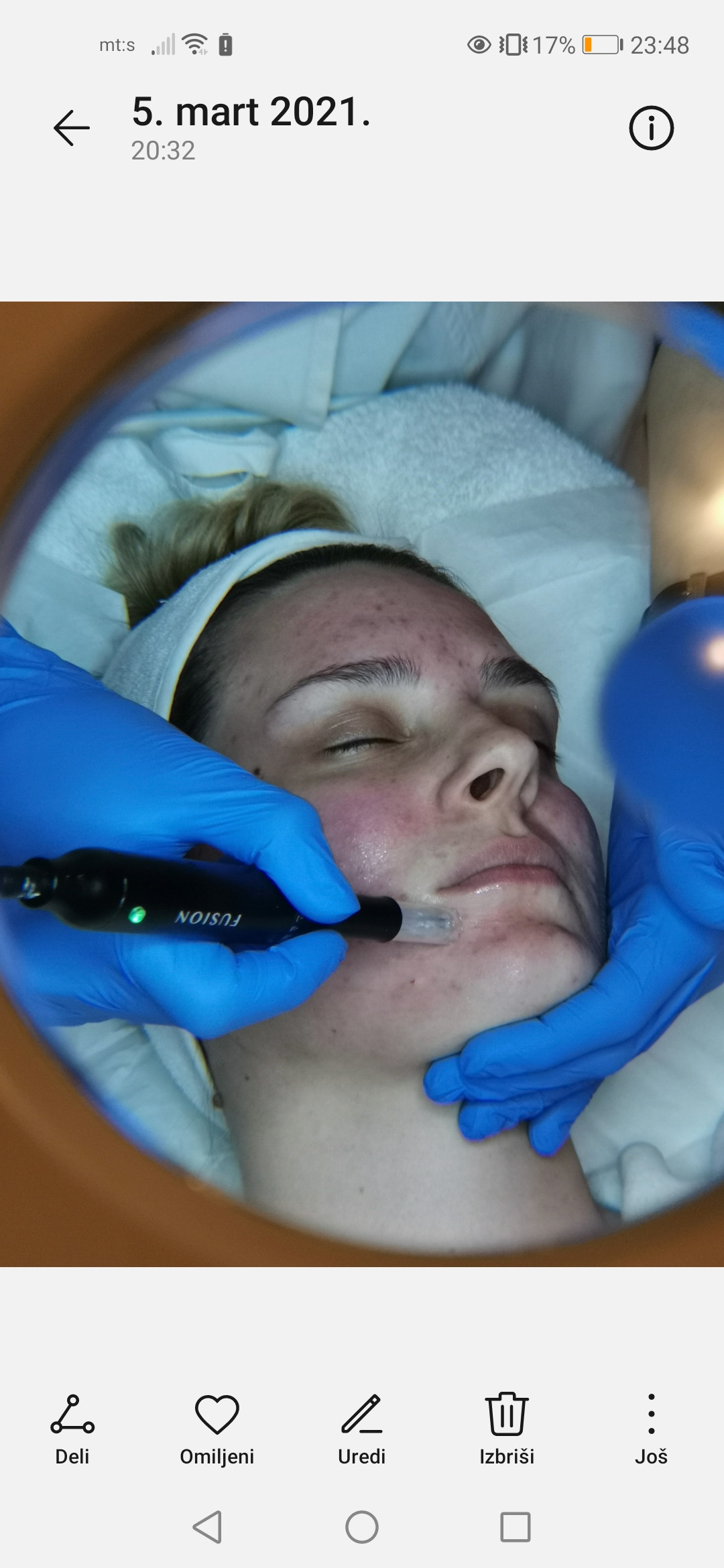 Glow beauty studio #beograd Tretman lica Dermapen