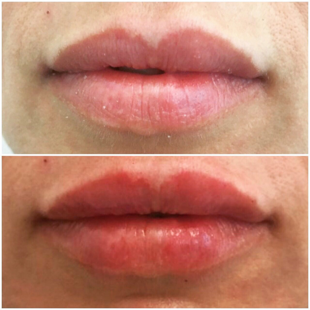 Be You #beograd Dermalni fileri Hijaluronski filer JUVÉDERM® - 1cc