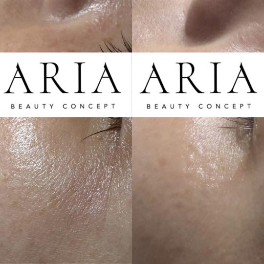 Aria Beauty Concept #pancevo Tretmani regije oko očiju Eyecon peel - regija oko očiju Pre i nakon 