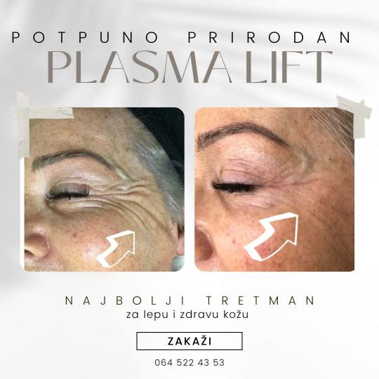 Lancier Beauty Expert #beograd Tretman lica Plazma lift lica - jedna regija