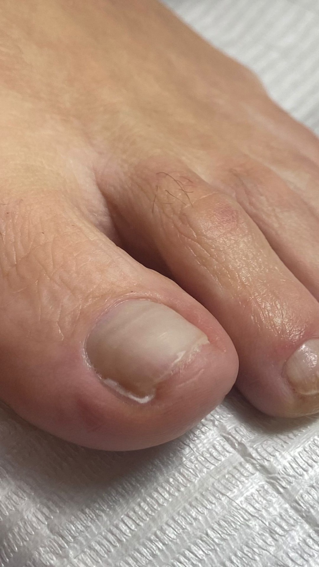 Tamponada - Touch Aesthetic&Medical care, Beograd Medicinski pedikir Nokti Medicinski pedikir, Beograd, Vračar, Čubura, Crveni krst