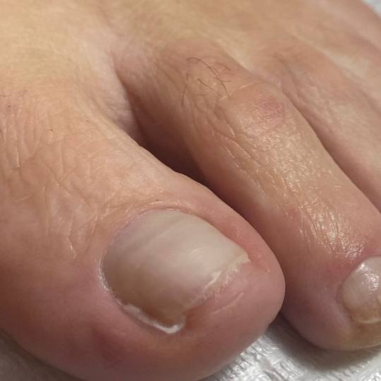 Touch Aesthetic&Medical care #beograd Medicinski pedikir Tamponada Medicinski pedikir