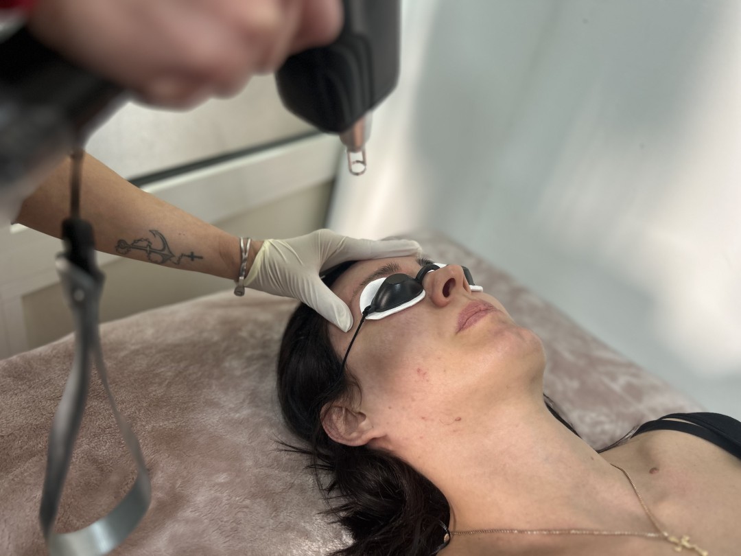 Beauty Studio S #beograd Obrve Skidanje obrva laserom