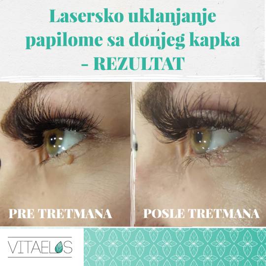 Vita Elos #novisad Laserski tretmani lica Uklanjanje papiloma sa kapaka Rezultate tretmana Uklanjanj