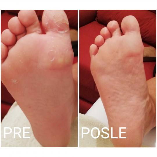 Vanila M #novisad medicinski pedikir