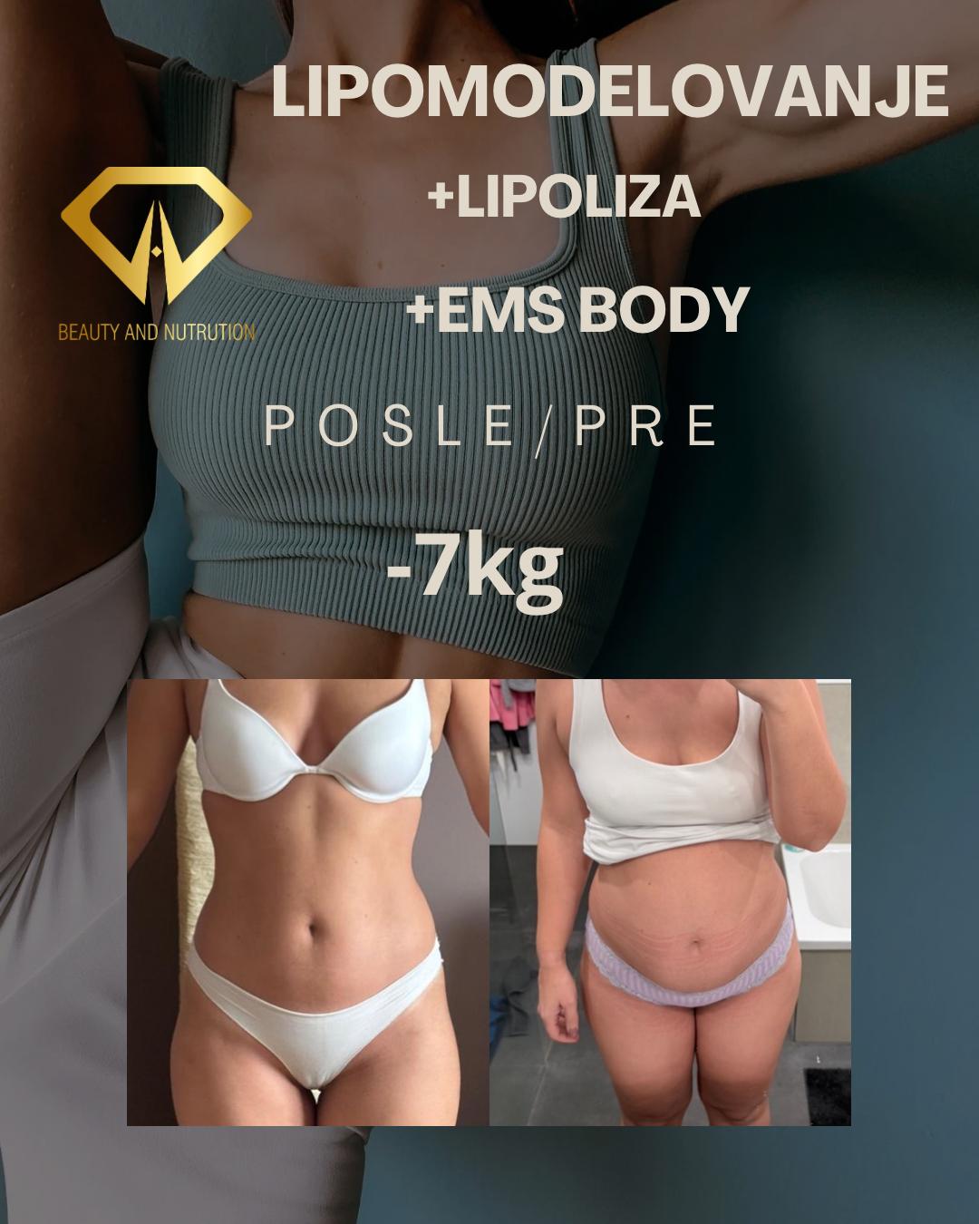 Beauty and nutrition #beograd Mezoterapija tela Lipoliza stomaka