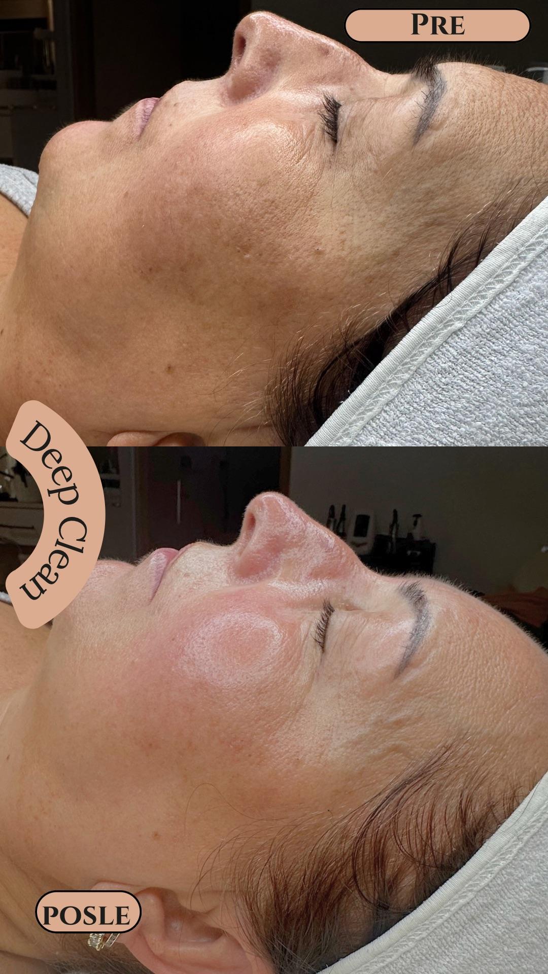 Deep Clean - higijenski tretman+ hydrafacial + UV špatula - Zen Club, Beograd Tretman lica Lice Tretman lica, Beograd, Vidikovac, Petlovo brdo, Labudovo brdo