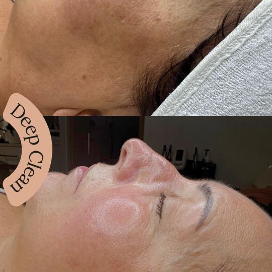 Zen Club #beograd Tretman lica Deep Clean - higijenski tretman+ hydrafacial + UV špatula Tretman ko