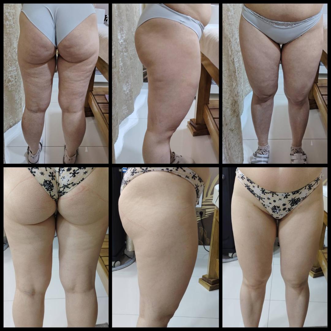 Diana Body & Hair Studio #beograd Tretmani tela Endosfera tela - paket od 7 tretmana + 5 gratis