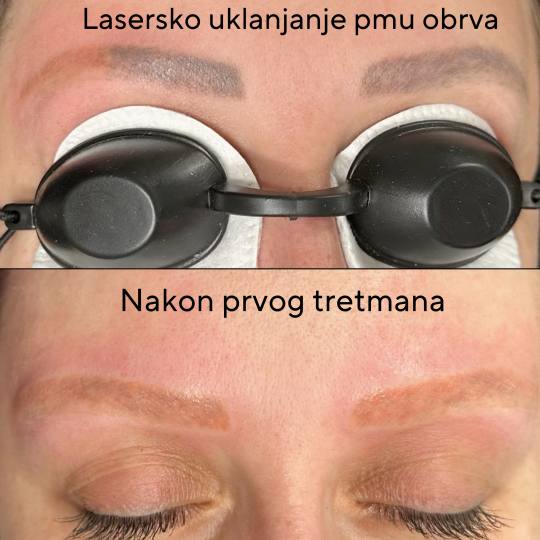 Kult #beograd Laserski tretmani lica Lasersko uklanjanje obrva