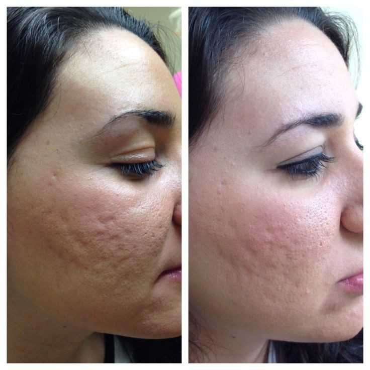 Golden Duo massage & Wellness studio #beograd Dermaroler i dermapen