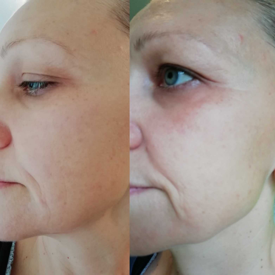 Olja Beauty #beograd Lifting / zatezanje kože HiFu tretman lica - po regiji