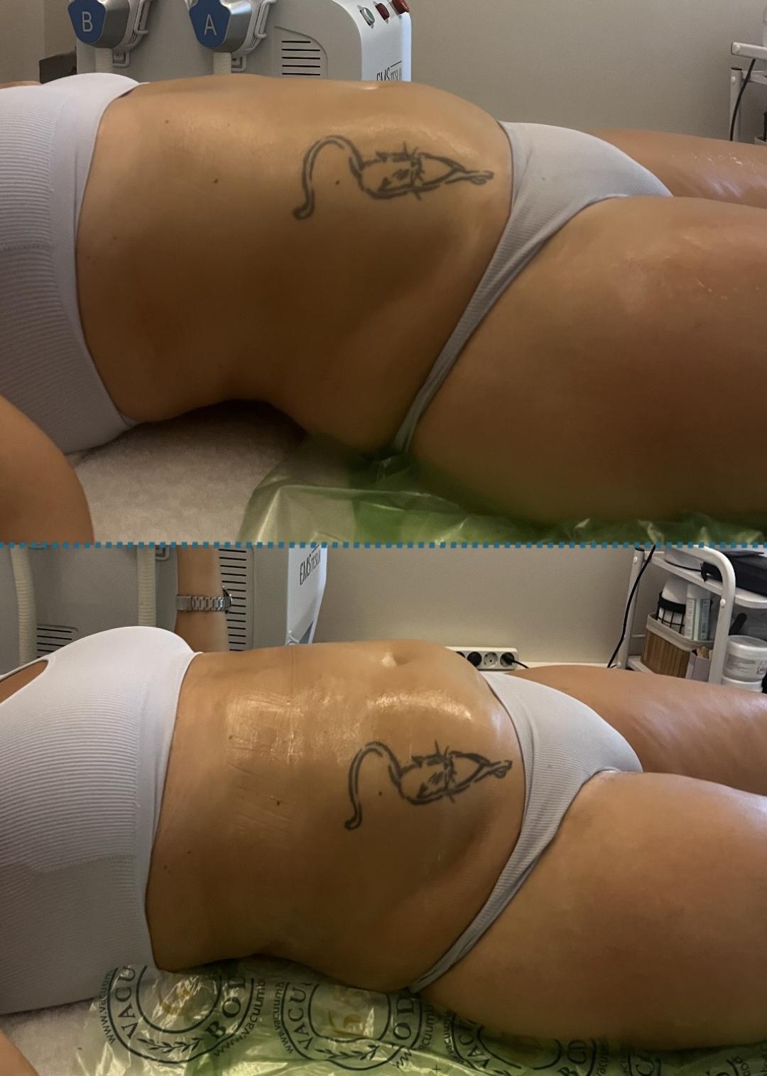 Vacum 65 body + limfna drenaža - Diamond beauty M, Beograd Anticelulit masaža Masaža Anticelulit masaža, Beograd, Zemun Centar