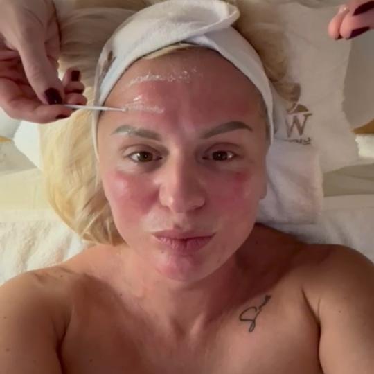 Glow Holistic Studio #beograd Dermaroler i dermapen Dermapen microneedling tretman lica;lica,vrata i