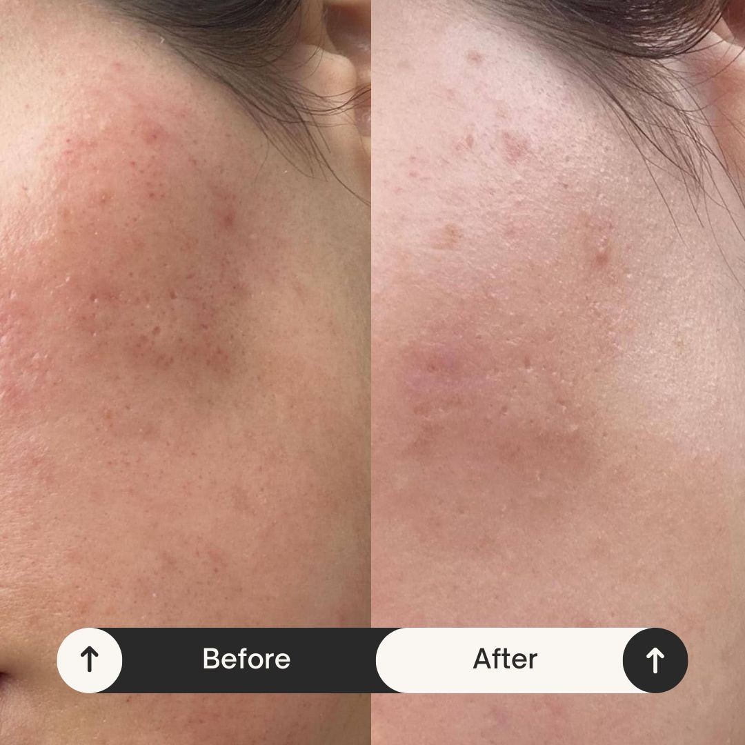 MediBella Aesthetic Dedinje #beograd Tretman lica Skin glow tretman - dermapen 4 + PRX + LED lampa + maska za lice