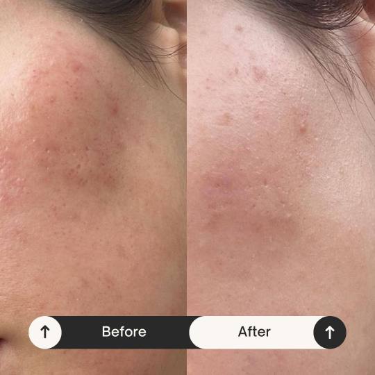 MediBella Aesthetic Dedinje #beograd Tretman lica Skin glow tretman - dermapen 4 + PRX + LED lampa +