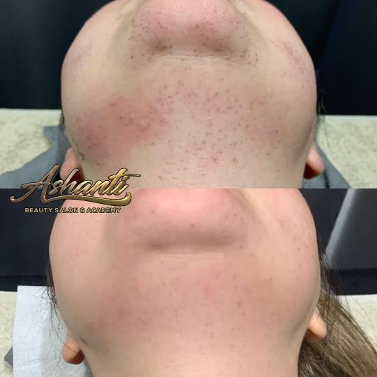 Ashanti Beauty Salon & Academy #beograd Laserska epilacija Laserska epilacija brade + podbrade