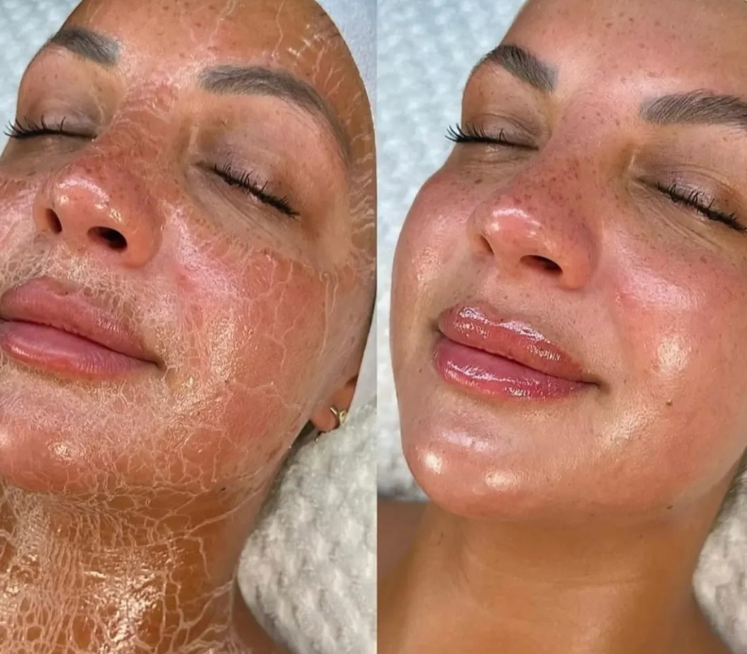 Botoks maska - Beauty and nutrition, Beograd Lifting / zatezanje kože Lice Lifting / zatezanje kože, Beograd, Zvezdara