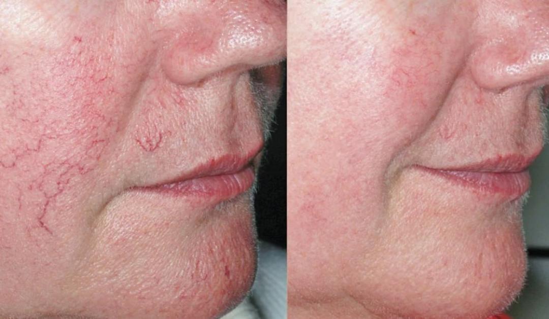 Anti cuperocse boost - Bella Lunika Estetic studio, Pančevo Tretman lica Lice Tretman lica, Pančevo, Centar