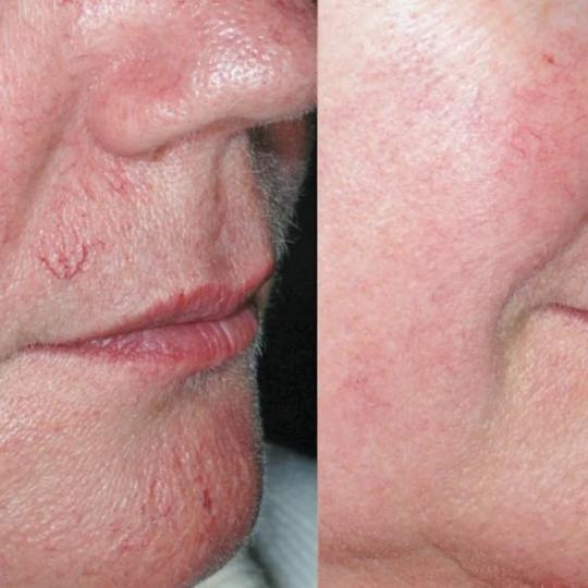 Bella Lunika Estetic studio #pancevo Tretman lica Anti cuperocse boost Rešavanje problema crvenila 