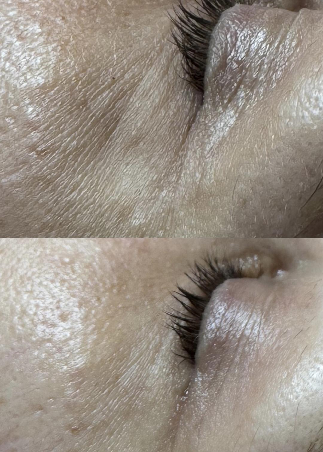 Aria Beauty Concept #pancevo Tretmani regije oko očiju Eyecon peel - regija oko očiju