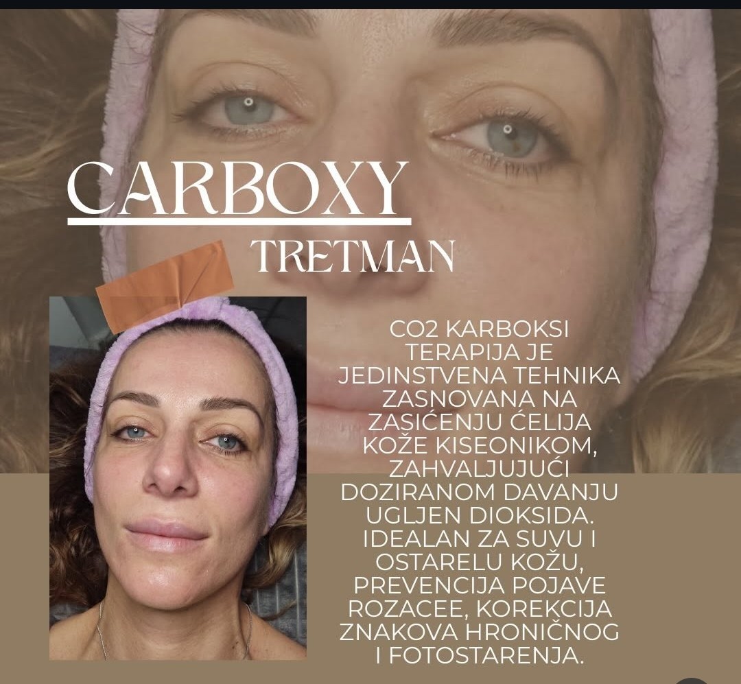 Studio 39 #beograd Tretman lica Carboxy tretman lica