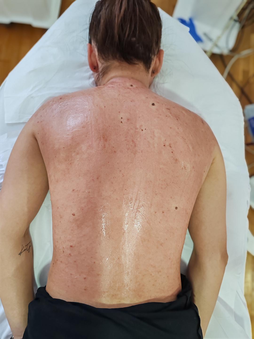 Dermapen tretman - leđa + ramena - Natural Beauty Lux, Beograd Mikrodermoabrazija Lice Mikrodermoabrazija, Beograd, Bežanijska kosa, Bežanija, Ledine, Surčin