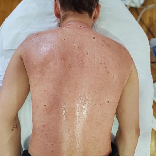 Natural Beauty Lux #beograd Mikrodermoabrazija Dermapen tretman - leđa + ramena Dermapen za leđa i