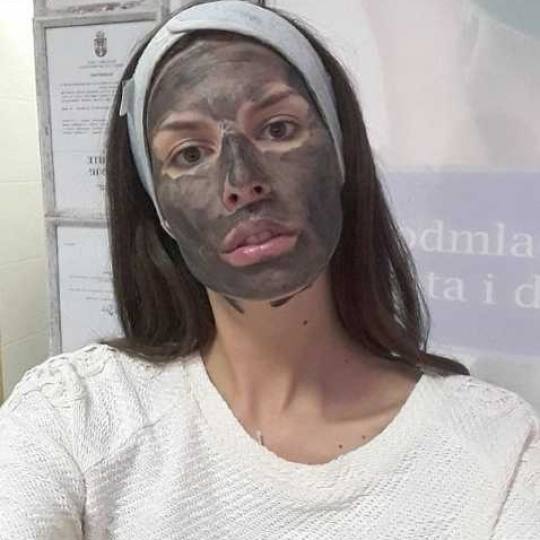 AltaBella Batajnica #beograd Tretman lica Laserski tretman Crna lutkica crna lutkica