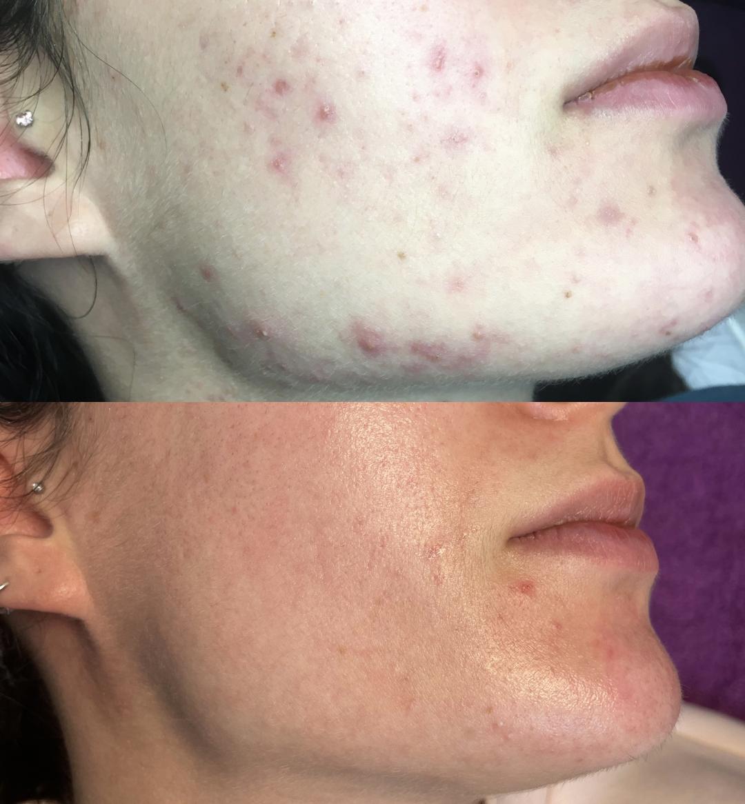 Mask #beograd Tretman lica Akne tretman lica