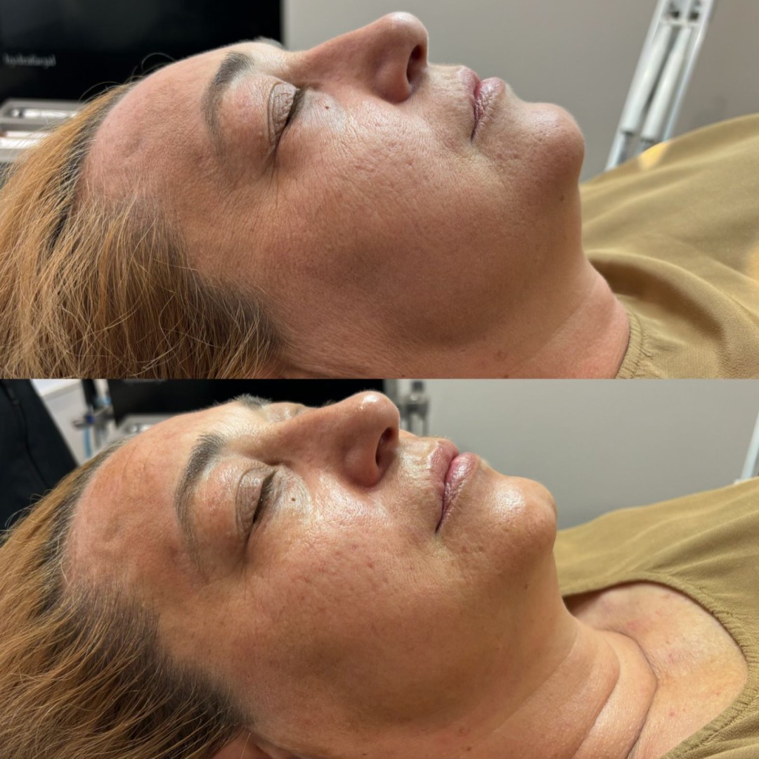 Prestige #beograd Tretman lica Circadia - SWICH DERMAL REJUVENATION SYSTEM TREATMENT