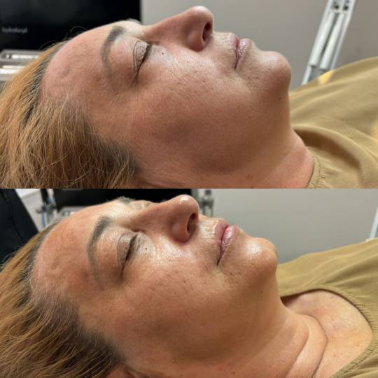 Prestige #beograd Tretman lica Circadia - SWICH DERMAL REJUVENATION SYSTEM TREATMENT Cirkadia Swich 