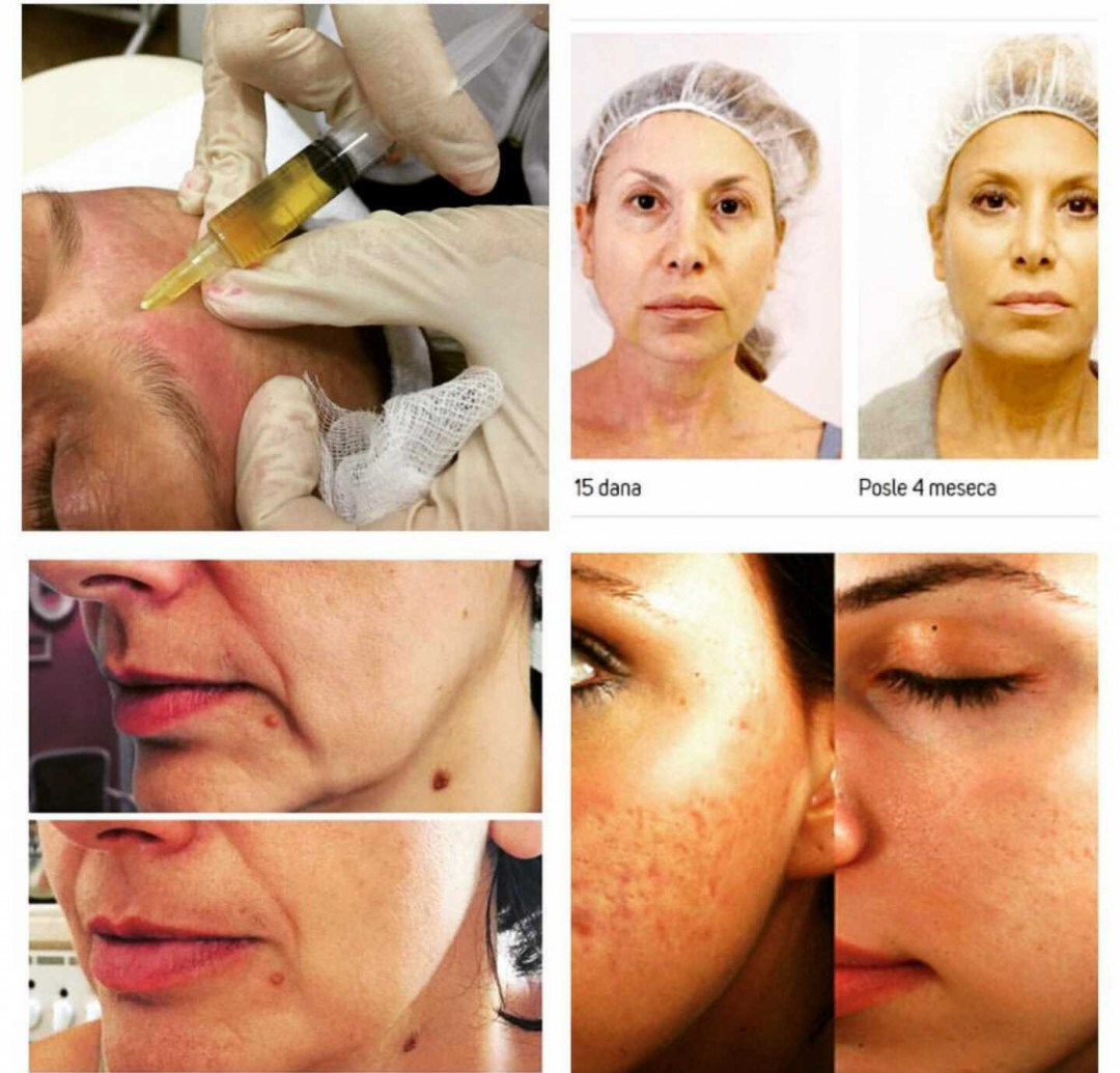 Grossi cosmetic #beograd Tretman lica