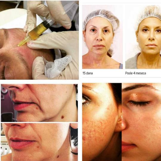 Grossi cosmetic #beograd Tretman lica