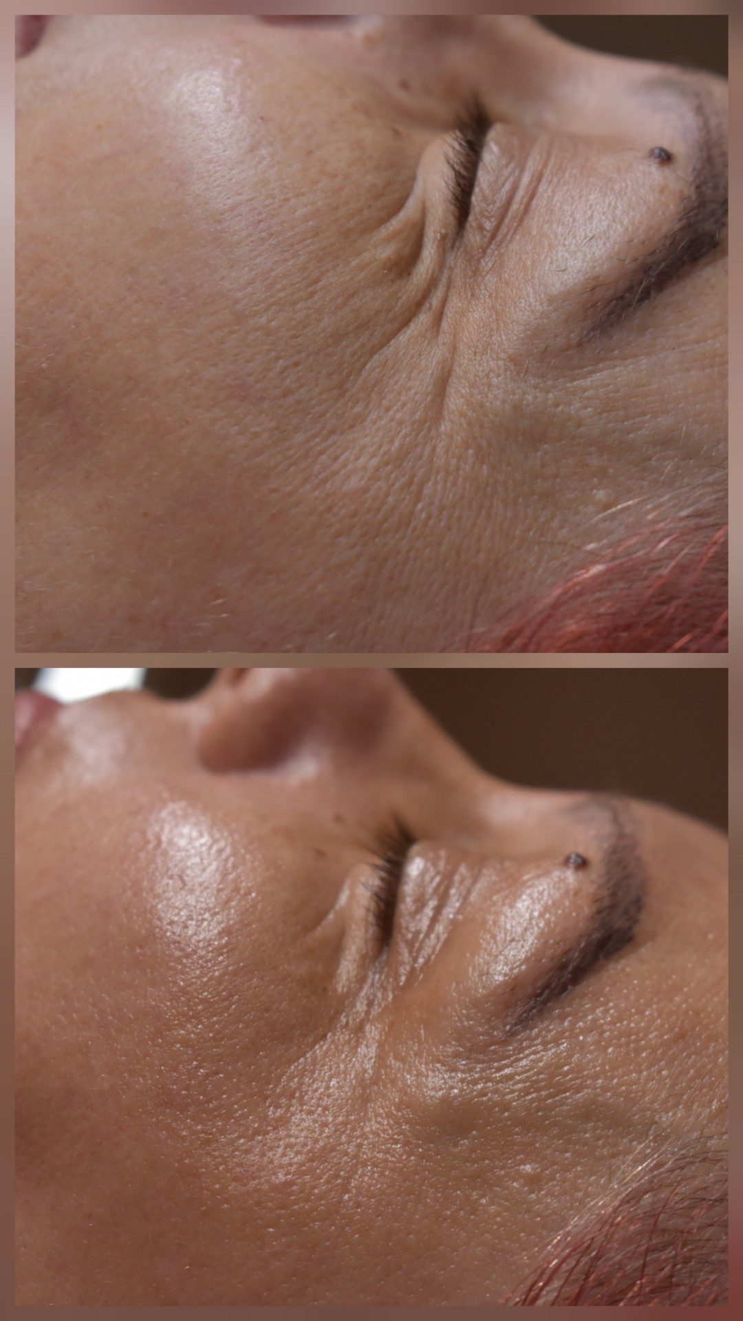 Bellavana studio #krusevac Lifting / zatezanje kože Skulpturalni face lifting