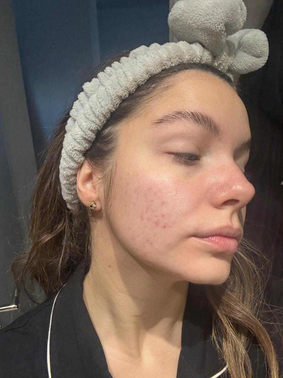 Moja Slavica #beograd Tretman lica Higijenski tretman lica - problematična koža